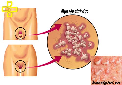 Mụn rộp sinh dục là gì