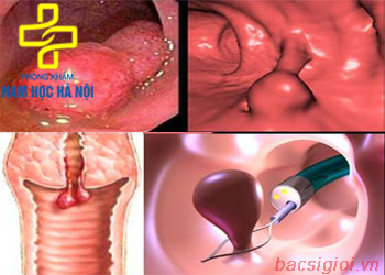 tac-hai-polyp-co-tu-cung