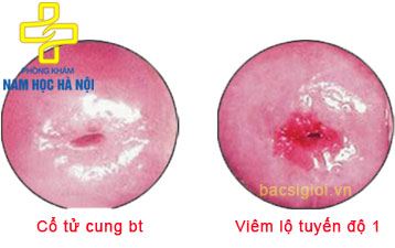 viem-lo-tuyen-co-tu-cung-la-gi