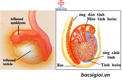 Bệnh u nang tinh hoàn ở nam giới
