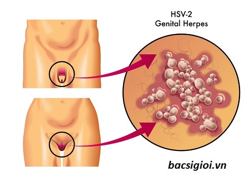 Con đường lây nhiễm virus HSV