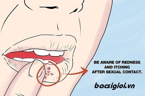 Nhận biết bệnh mụn rộp sinh dục ở miệng